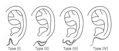 耳垂裂的四个程度