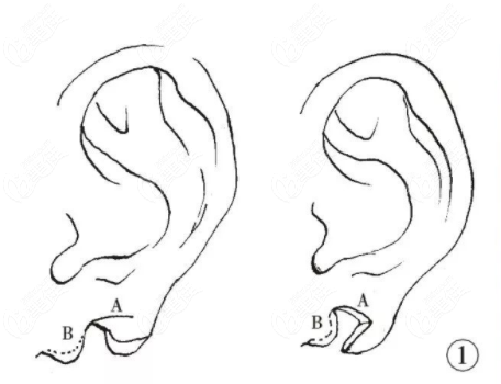“耳垂裂Z成形术方法”